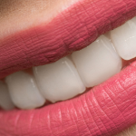 Clareamento Dental em Curitiba