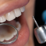 Restauração Dentária em Curitiba