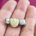 restaurações dentárias